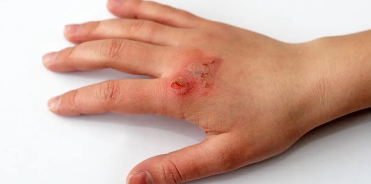 Successful Homemade Remedies to Handle Small Burns